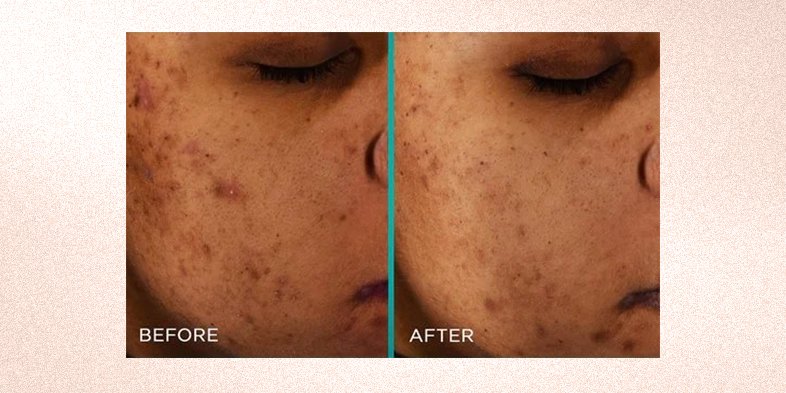 In Article How To Restore Radiance To A Dull Skin Tone Bright Reveal 12 Niacinamide Dark Spot Serum